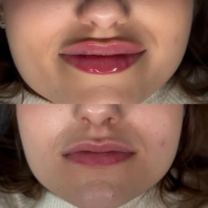 Usta przed i po zabiegu modelowania w angelbeauty.ak